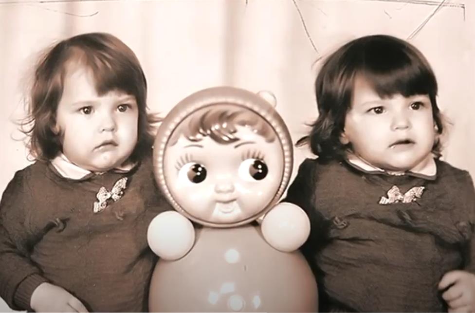 Sijamske Bliznakinje Ana i Tanja Korkinova u detinjstvu.jpg