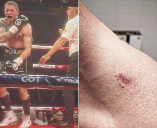 Đorđe Stojković, boks, ujed