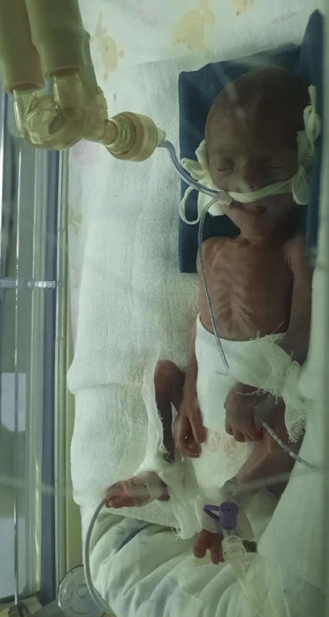 Kruna prevremeno rođena beba