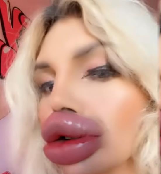 Vijena Vurstel ima najveće usne na svetu