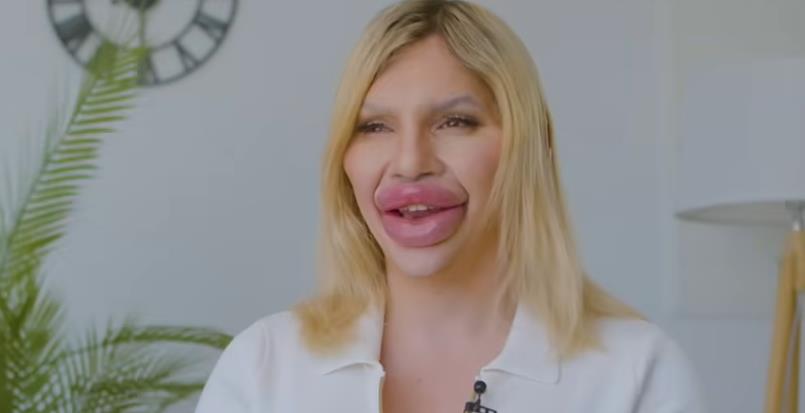 Vijena Vurstel ima najveće usne na svetu