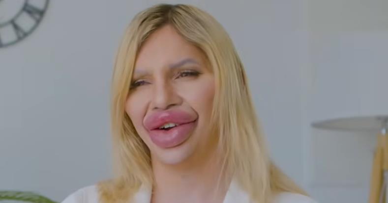 Vijena Vurstel ima najveće usne na svetu