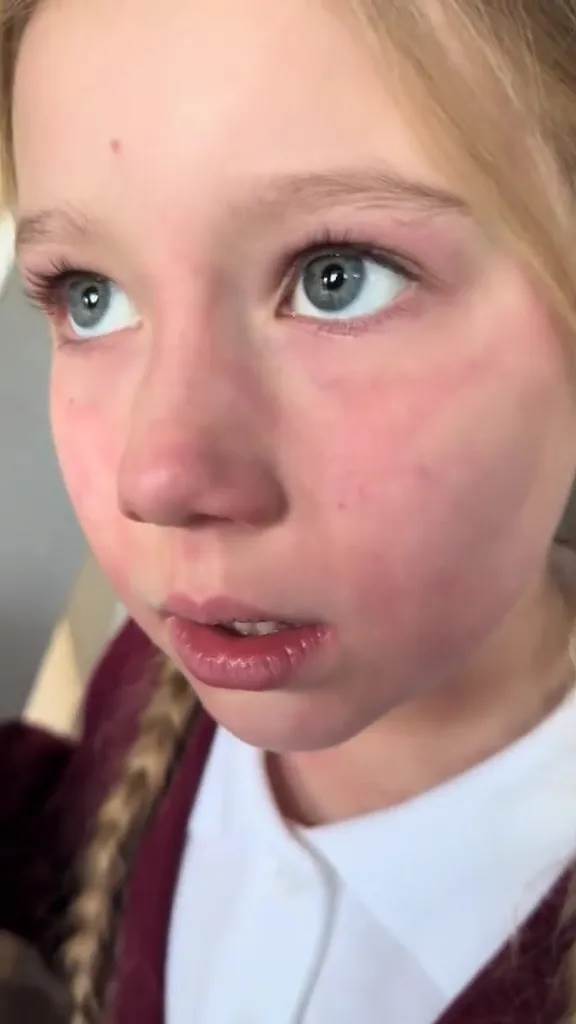 alergija na hladnoću.jpg