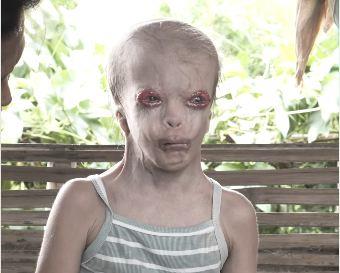 Aleksandra Guadajo - devojčica rođena bez kapaka