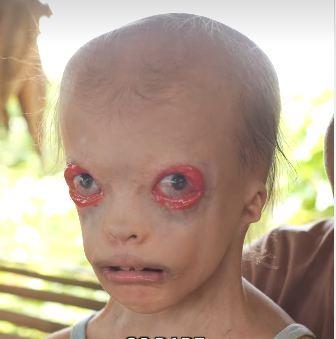 Aleksandra Guadajo - devojčica rođena bez kapaka