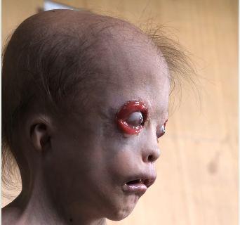 Aleksandra Guadajo - devojčica rođena bez kapaka