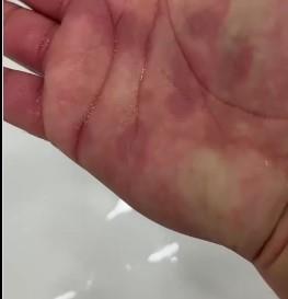 "STANIJA NIJE IZMIŠLJALA" Otac Asmina Durdžića pokazao sa kakvim kožnim problemima se bori njegov sin (FOTO)