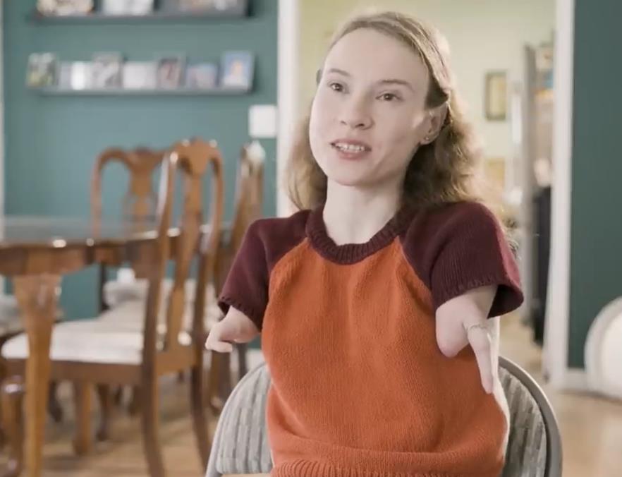 Debora Del - rođena sa tetrafokomelijom