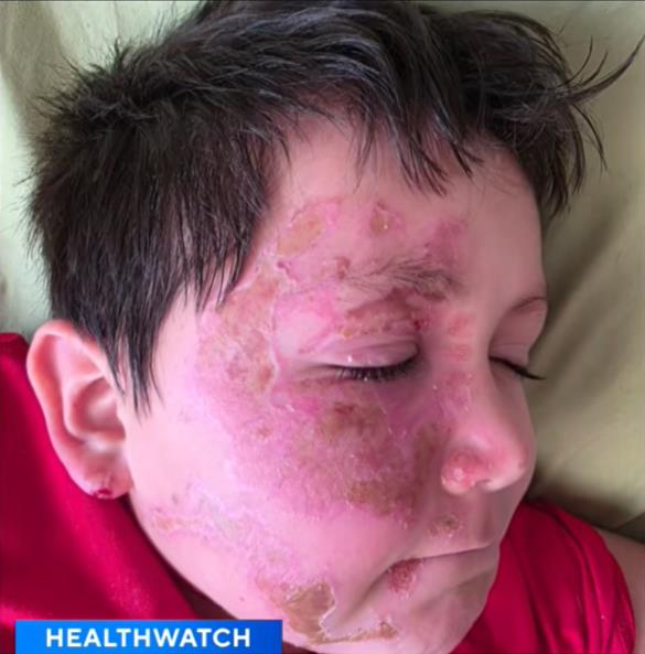 Dečak Kejleb Čabola dobio opekotine zbog TikTok trenda