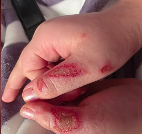 Dečak Kejleb Čabola dobio opekotine zbog TikTok trenda