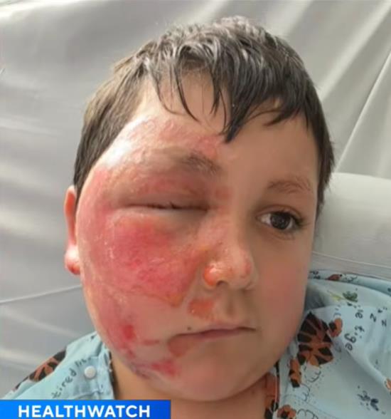 Dečak Kejleb Čabola dobio opekotine zbog TikTok trenda