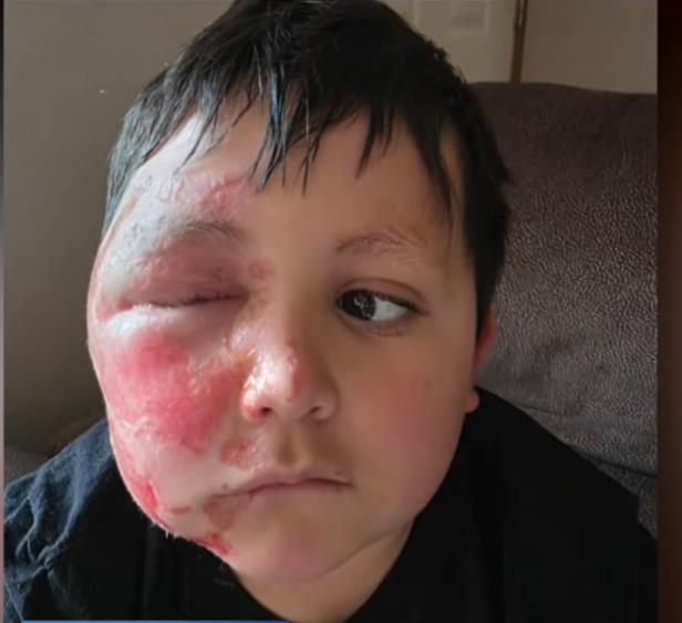 Dečak Kejleb Čabola dobio opekotine zbog TikTok trenda