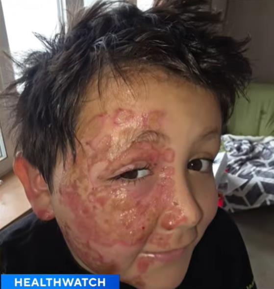 Dečak Kejleb Čabola dobio opekotine zbog TikTok trenda