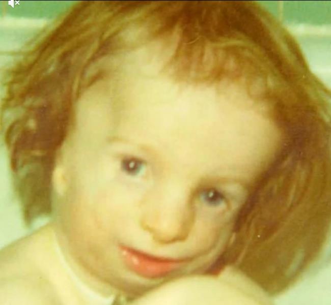 Frensis Džoel Smit - rođen sa Tričer Kolins sindromom