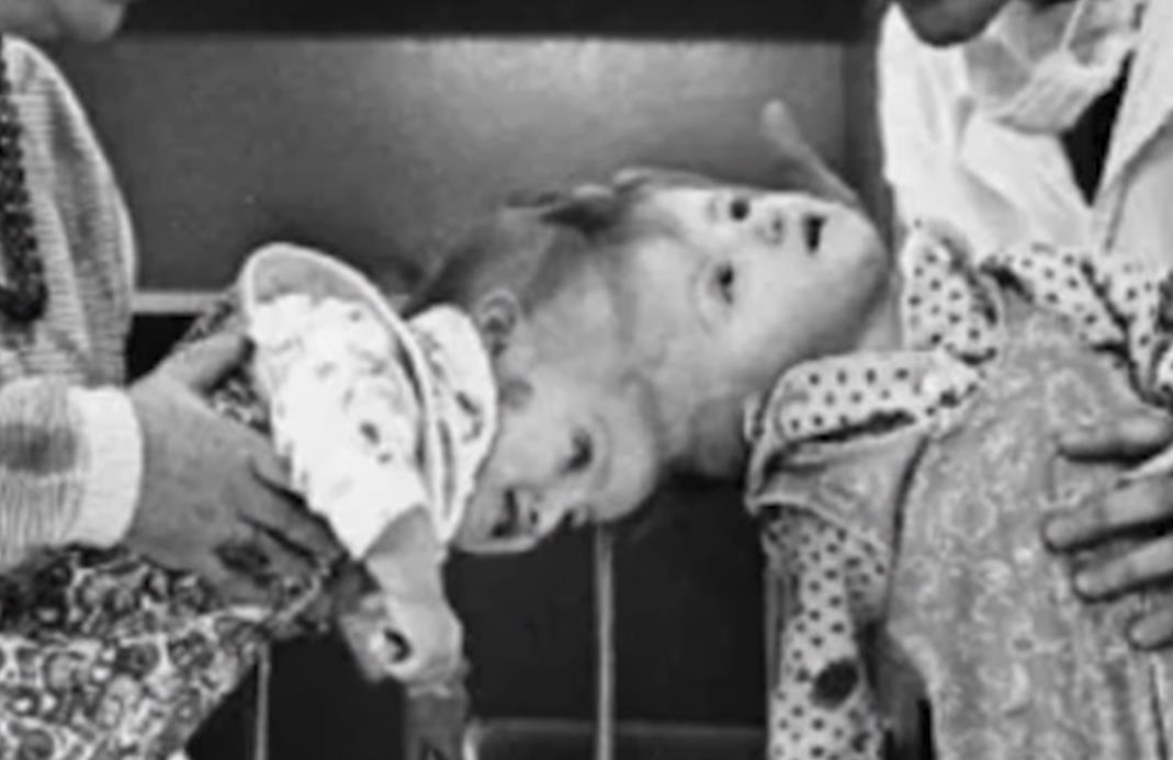 Sijamske bliznakinje Vilija i Vitalija