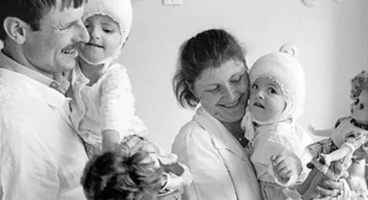 Sijamske bliznakinje Vilija i Vitalija