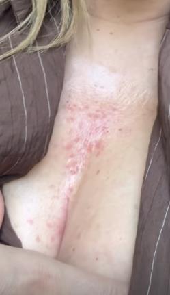 Nives Celzijus pokazala osip i crvenilo po koži