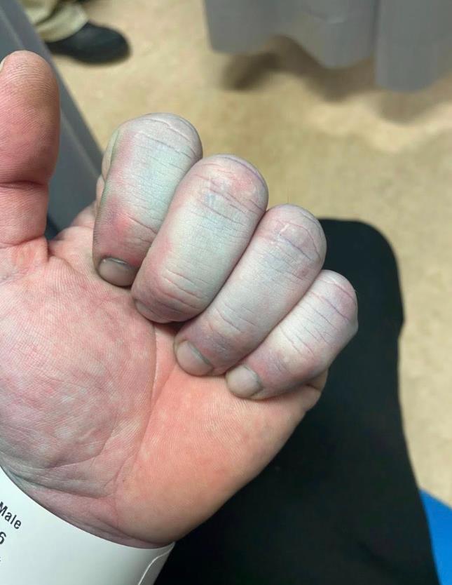 Muškarac sa plavom bojom kože nakon spavanja u novoj posteljini (5).PNG