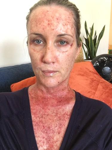 Kori Felc - probudila se tokom operacije raka kože na usni