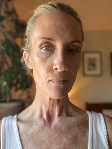 Kori Felc - probudila se tokom operacije raka kože na usni