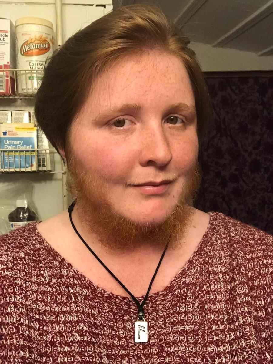 Megan Rajli Nili-Stivenson iz Tenesija ponosno pokazuje bradu koju ima zbog hirsutizma