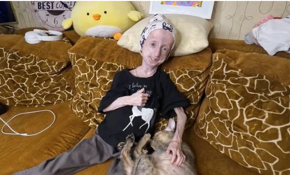 Anja Korčagina, devojka čiji je život obeležen progerijom