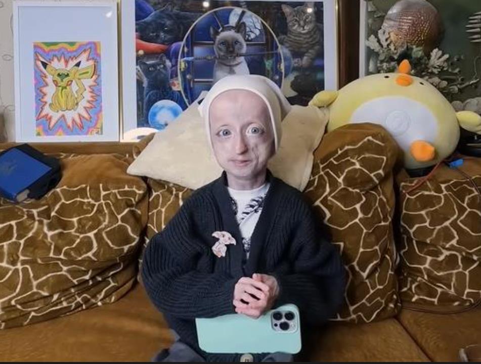 Anja Korčagina, devojka čiji je život obeležen progerijom