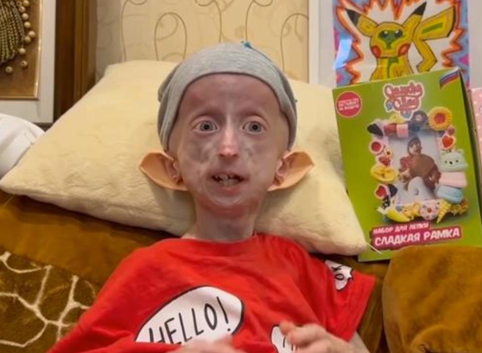 Anja Korčagina, devojka čiji je život obeležen progerijom