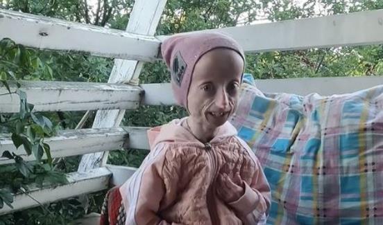 Anja Korčagina, devojka čiji je život obeležen progerijom