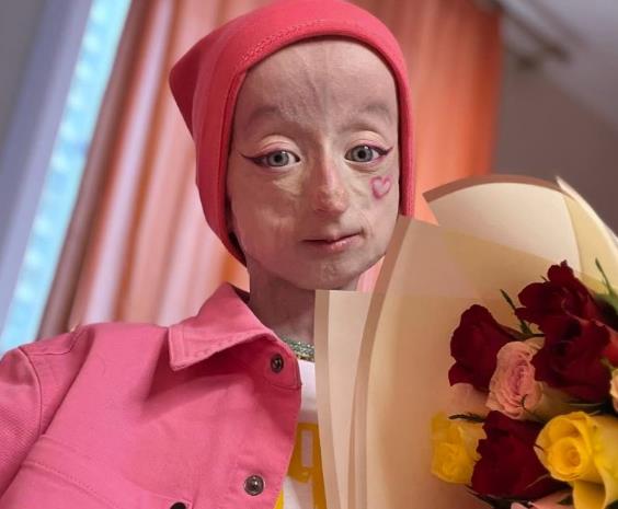 Anja Korčagina, devojka čiji je život obeležen progerijom