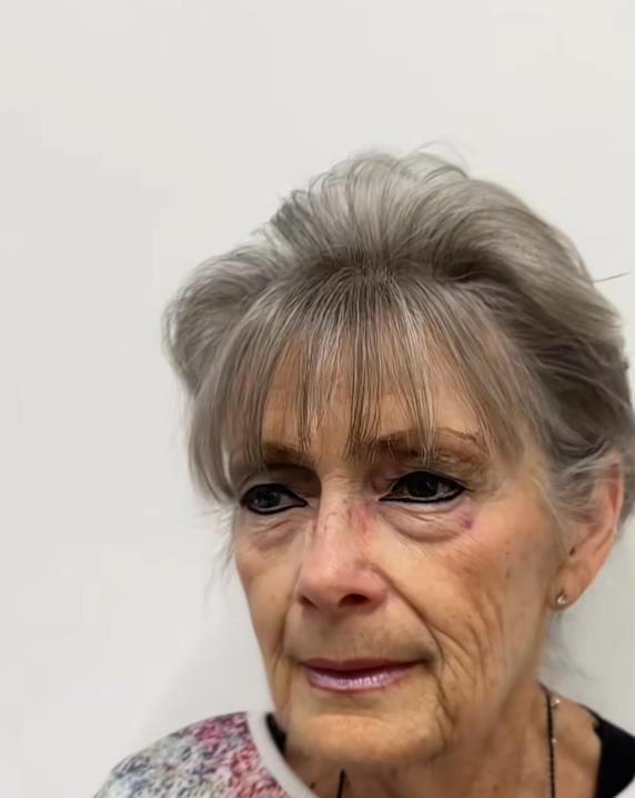 Žena pre fejsliftinga sa drastičnom promenom izgleda (3).png