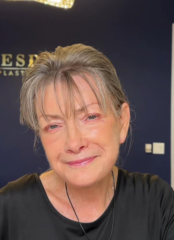 Žena posle fejsliftinga sa drastičnom promenom izgleda (1).jpg