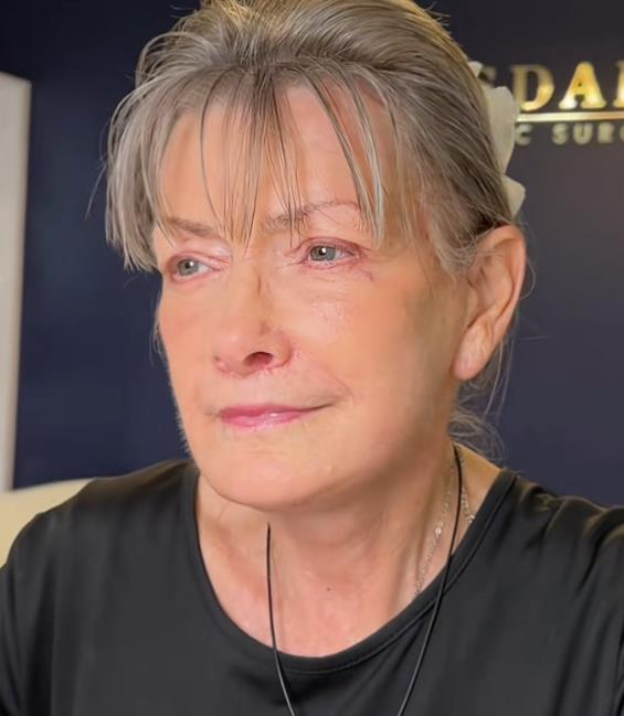 Žena posle fejsliftinga sa drastičnom promenom izgleda (3).png