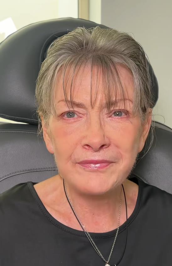 Žena posle fejsliftinga sa drastičnom promenom izgleda (4).png