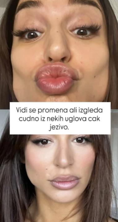 Edita Aradinović o estetskim zahvatima