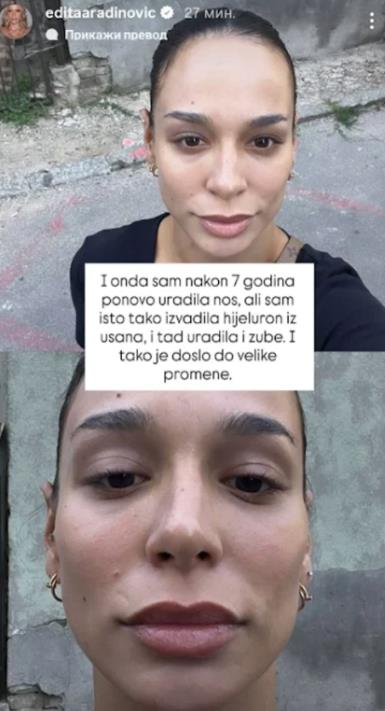 Edita Aradinović o estetskim zahvatima