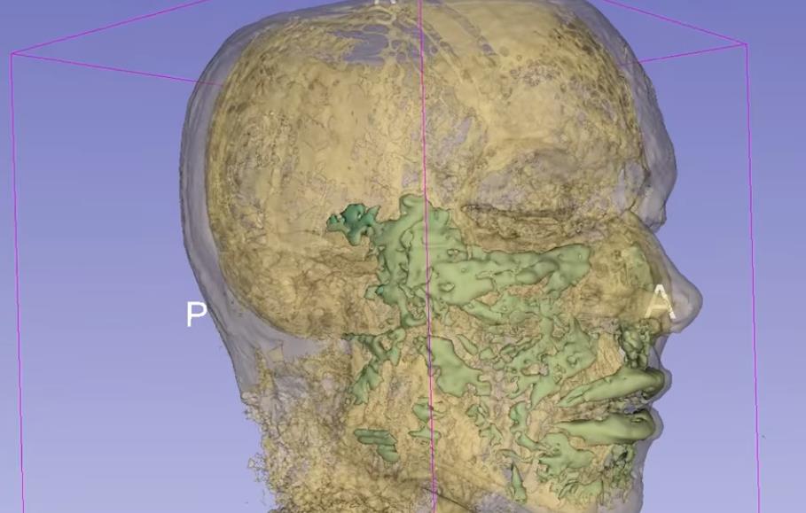 fileri, magnetna rezonanca