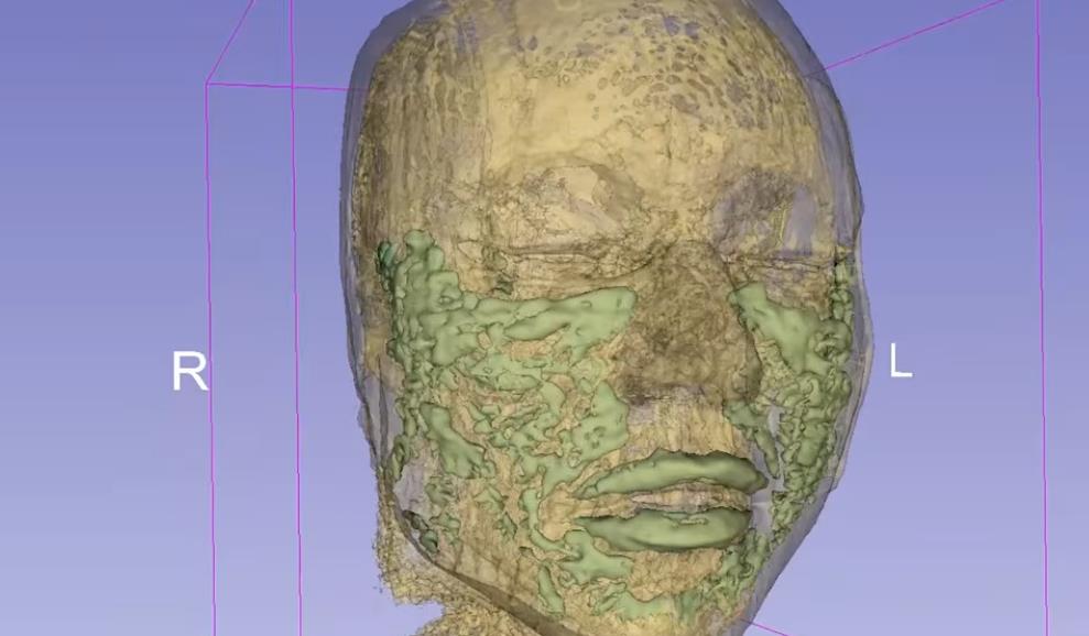 fileri, magnetna rezonanca