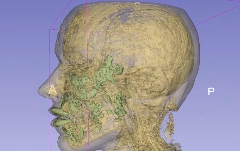 fileri, magnetna rezonanca