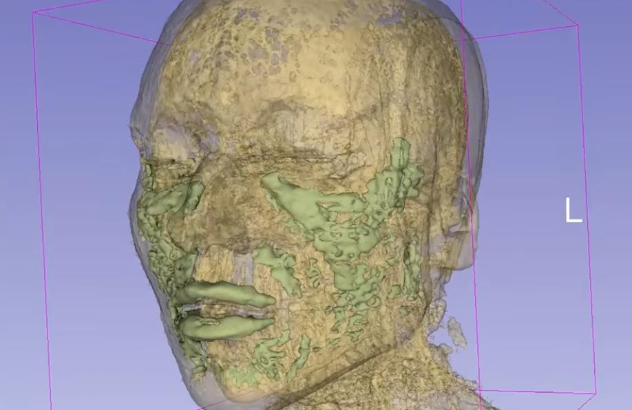 fileri, magnetna rezonanca