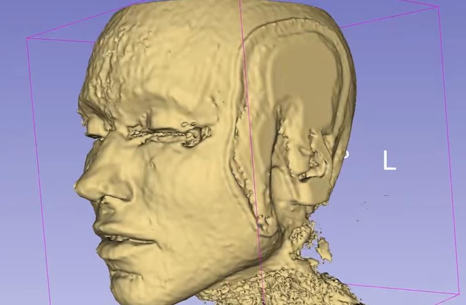 fileri, magnetna rezonanca