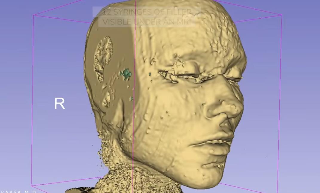 fileri, magnetna rezonanca