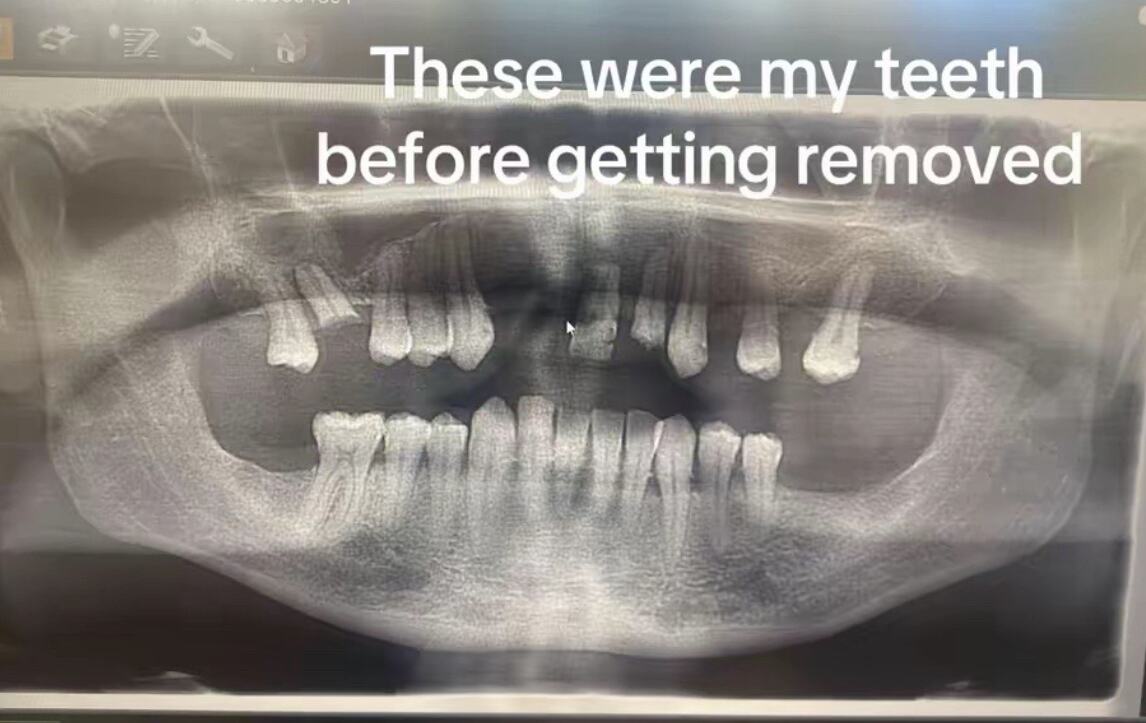 Džon Denton ostao bez zuba u Turskoj (2).png