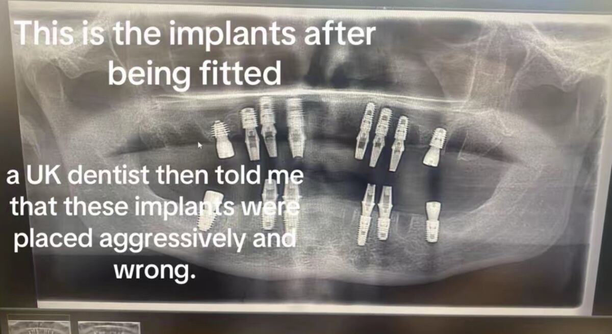 Džon Denton ostao bez zuba u Turskoj (3).png