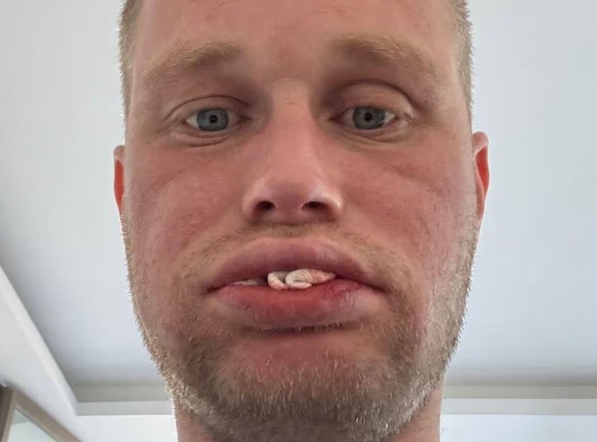 Džon Denton ostao bez zuba u Turskoj (4).png