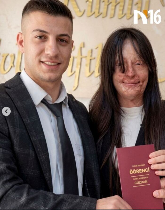 Berfin Ozek, udala se za bivšeg koji joj je bacio kiselinu u lice