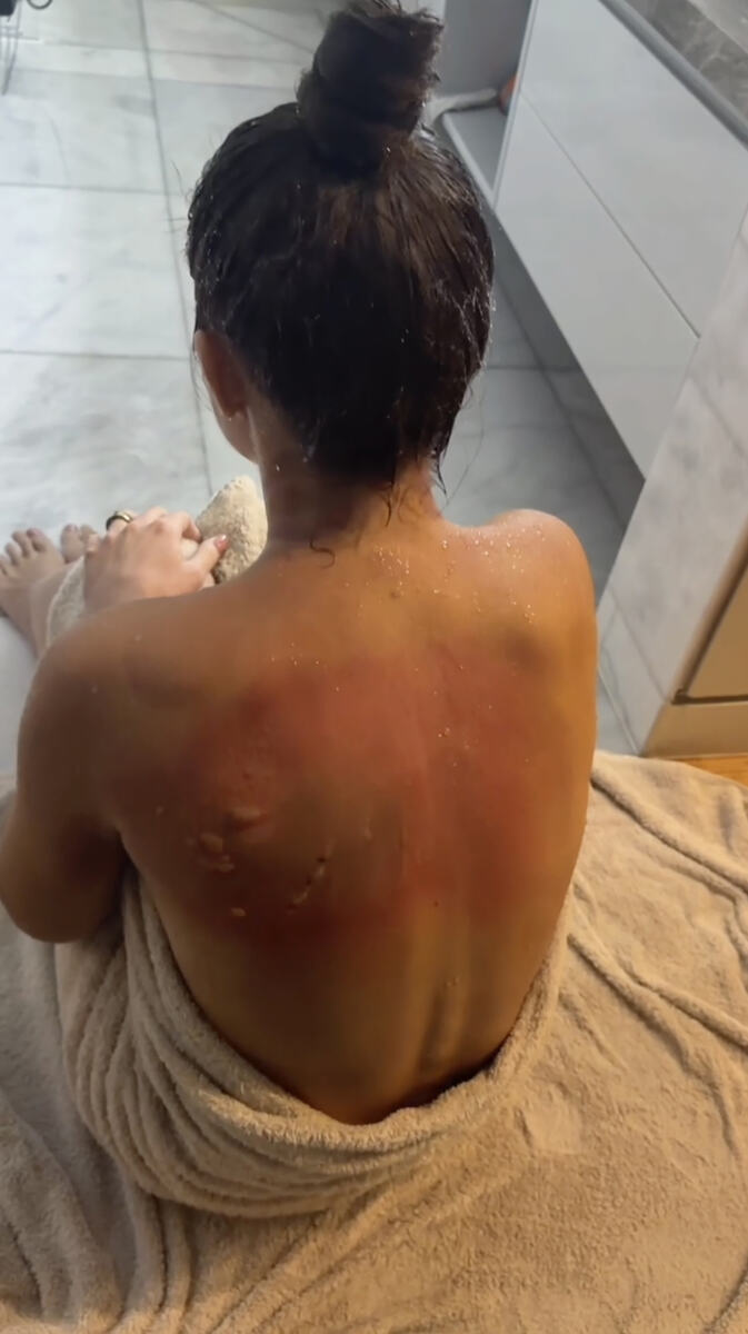 Ana Otavina - zadobila teške opekotine kad joj je tokom noći eksplodirao punjač za telefon