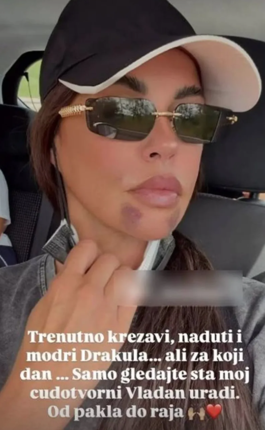 Dijana Dilajn slomila vilicu, izvadili joj osam zuba