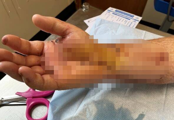 Piter Marfi umalo ostao bez ruke nakon ujeda pauka
