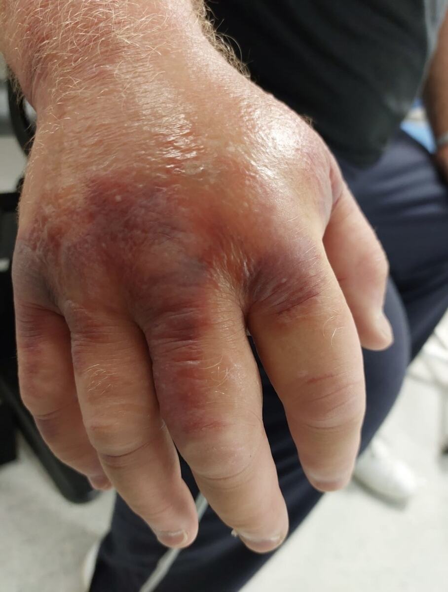 Piter Marfi umalo ostao bez ruke nakon ujeda pauka